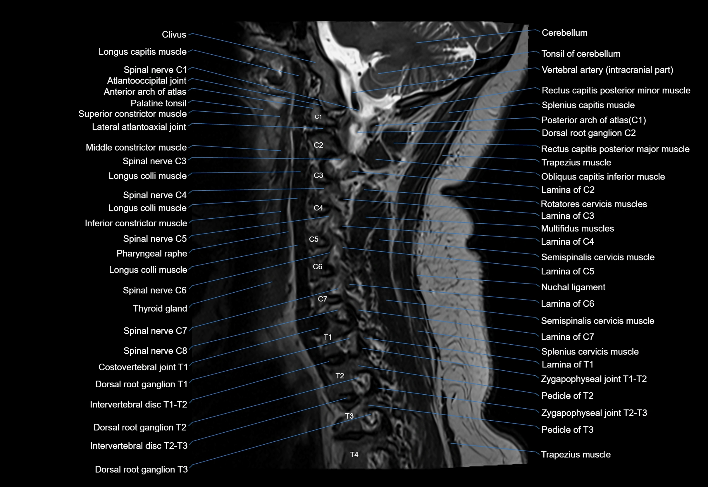 cervical spine cross sectional MRI anatomy 3T MRI  sagittal image-img-00001-00022.webp